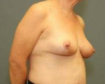 BREAST LIFT AFTER WEIGHT LOSS: Case 53 After